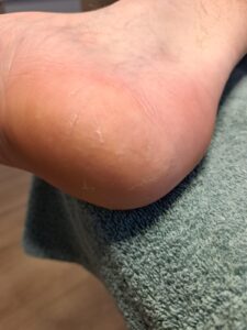 hielkloof behandeling pedicure ursem koggenland