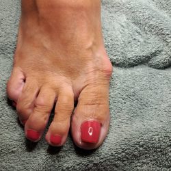 eelt verwijderen pedicurebehandeling na ursem noord holland