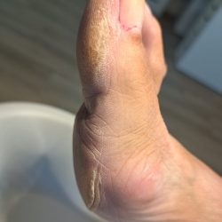 eelt verwijderen pedicurebehandeling ursem noord holland voor