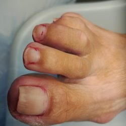 eelt verwijderen voor pedicurebehandeling ursem noord holland